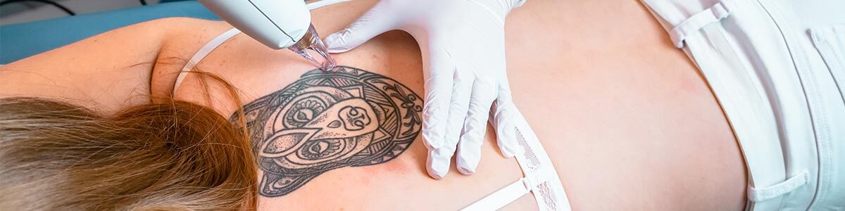 Tattooentfernung in München